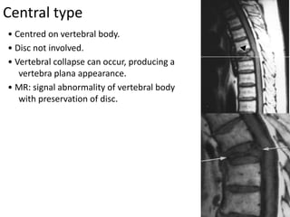Central type
• Centred on vertebral body.
• Disc not involved.
• Vertebral collapse can occur, producing a
vertebra plana appearance.
• MR: signal abnormality of vertebral body
with preservation of disc.
 