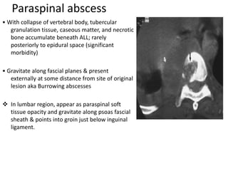 Paraspinal abscess
• With collapse of vertebral body, tubercular
granulation tissue, caseous matter, and necrotic
bone accumulate beneath ALL; rarely
posteriorly to epidural space (significant
morbidity)
• Gravitate along fascial planes & present
externally at some distance from site of original
lesion aka Burrowing abscesses
 In lumbar region, appear as paraspinal soft
tissue opacity and gravitate along psoas fascial
sheath & points into groin just below inguinal
ligament.
 