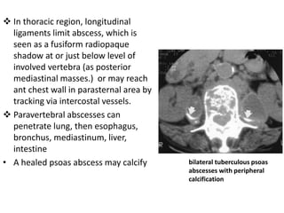  In thoracic region, longitudinal
ligaments limit abscess, which is
seen as a fusiform radiopaque
shadow at or just below level of
involved vertebra (as posterior
mediastinal masses.) or may reach
ant chest wall in parasternal area by
tracking via intercostal vessels.
 Paravertebral abscesses can
penetrate lung, then esophagus,
bronchus, mediastinum, liver,
intestine
• A healed psoas abscess may calcify bilateral tuberculous psoas
abscesses with peripheral
calcification
 