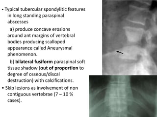 • Typical tubercular spondylitic features
in long standing paraspinal
abscesses
a} produce concave erosions
around ant margins of vertebral
bodies producing scalloped
appearance called Aneurysmal
phenomenon.
b} bilateral fusiform paraspinal soft
tissue shadow (out of proportion to
degree of osseous/discal
destruction) with calcifications.
• Skip lesions as involvement of non
contiguous vertebrae (7 – 10 %
cases).
 