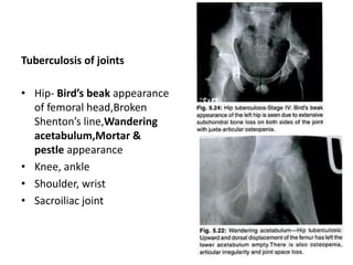 Tuberculosis of joints
• Hip- Bird’s beak appearance
of femoral head,Broken
Shenton’s line,Wandering
acetabulum,Mortar &
pestle appearance
• Knee, ankle
• Shoulder, wrist
• Sacroiliac joint
 