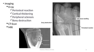 Comprehensive Overview of Bone and Joint Infections: Osteomyelitis and ...