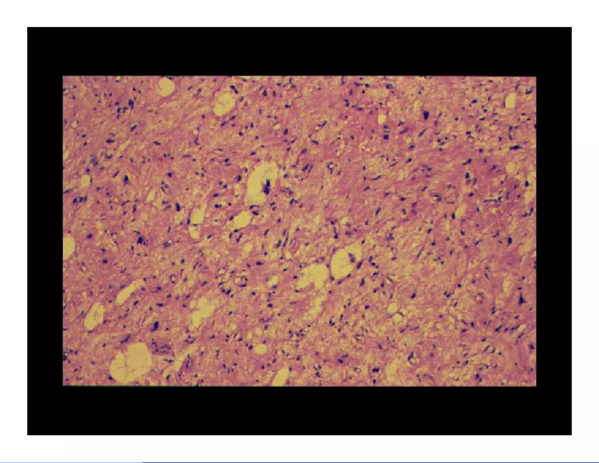 Bone and soft tissue pathology | PPTX