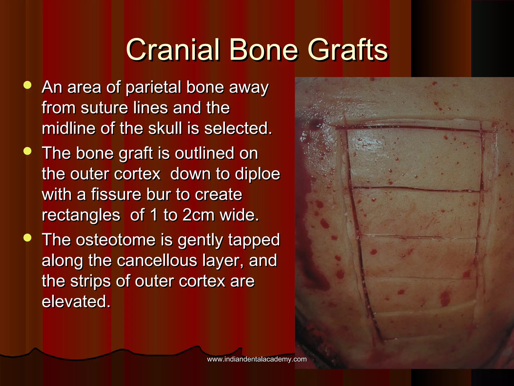 Cranial Bone GraftsCranial Bone Grafts
 An area of parietal bone awayAn area of parietal bone away
from suture lines and thefrom suture lines and the
midline of the skull is selected.midline of the skull is selected.
 The bone graft is outlined onThe bone graft is outlined on
the outer cortex down to diploethe outer cortex down to diploe
with a fissure bur to createwith a fissure bur to create
rectangles of 1 to 2cm wide.rectangles of 1 to 2cm wide.
 The osteotome is gently tappedThe osteotome is gently tapped
along the cancellous layer, andalong the cancellous layer, and
the strips of outer cortex arethe strips of outer cortex are
elevated.elevated.
www.indiandentalacademy.comwww.indiandentalacademy.com
 