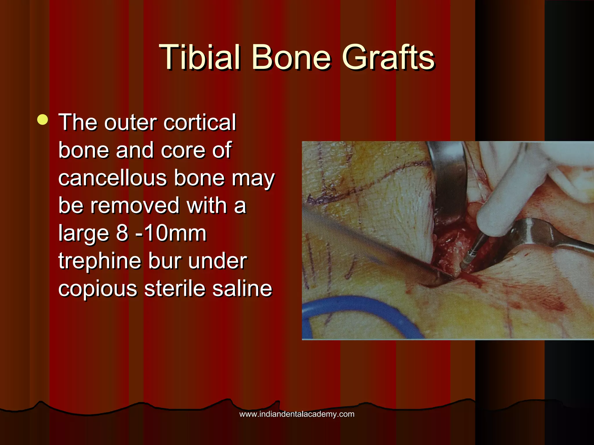 Tibial Bone GraftsTibial Bone Grafts
 The outer corticalThe outer cortical
bone and core ofbone and core of
cancellous bone maycancellous bone may
be removed with abe removed with a
large 8 -10mmlarge 8 -10mm
trephine bur undertrephine bur under
copious sterile salinecopious sterile saline
www.indiandentalacademy.comwww.indiandentalacademy.com
 