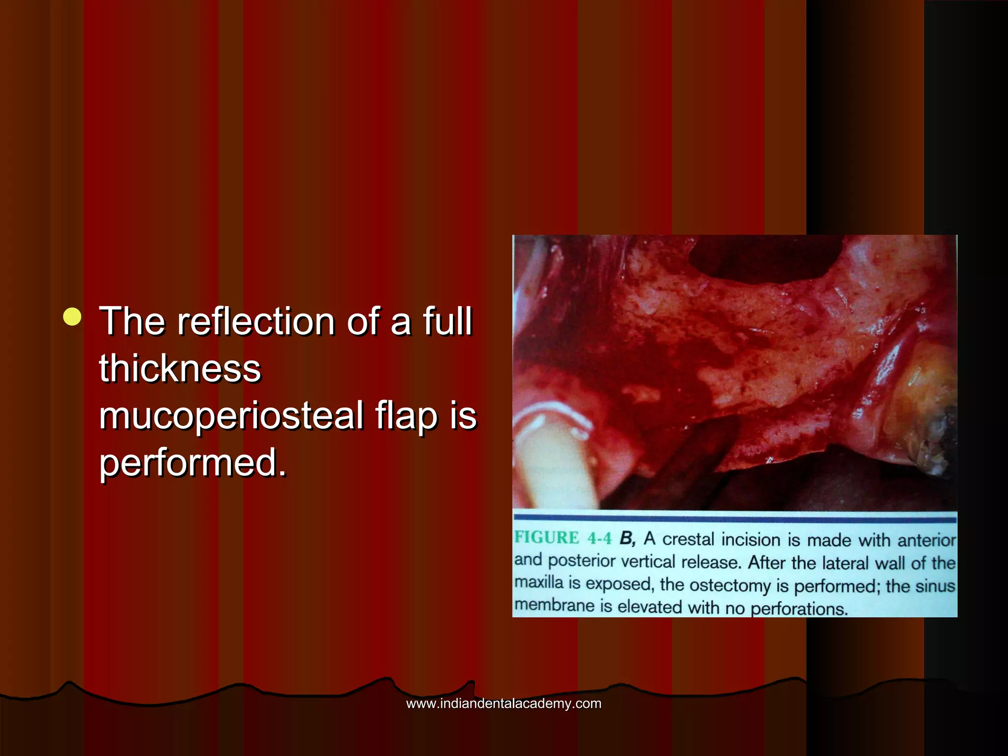  The reflection of a fullThe reflection of a full
thicknessthickness
mucoperiosteal flap ismucoperiosteal flap is
performed.performed.
www.indiandentalacademy.comwww.indiandentalacademy.com
 