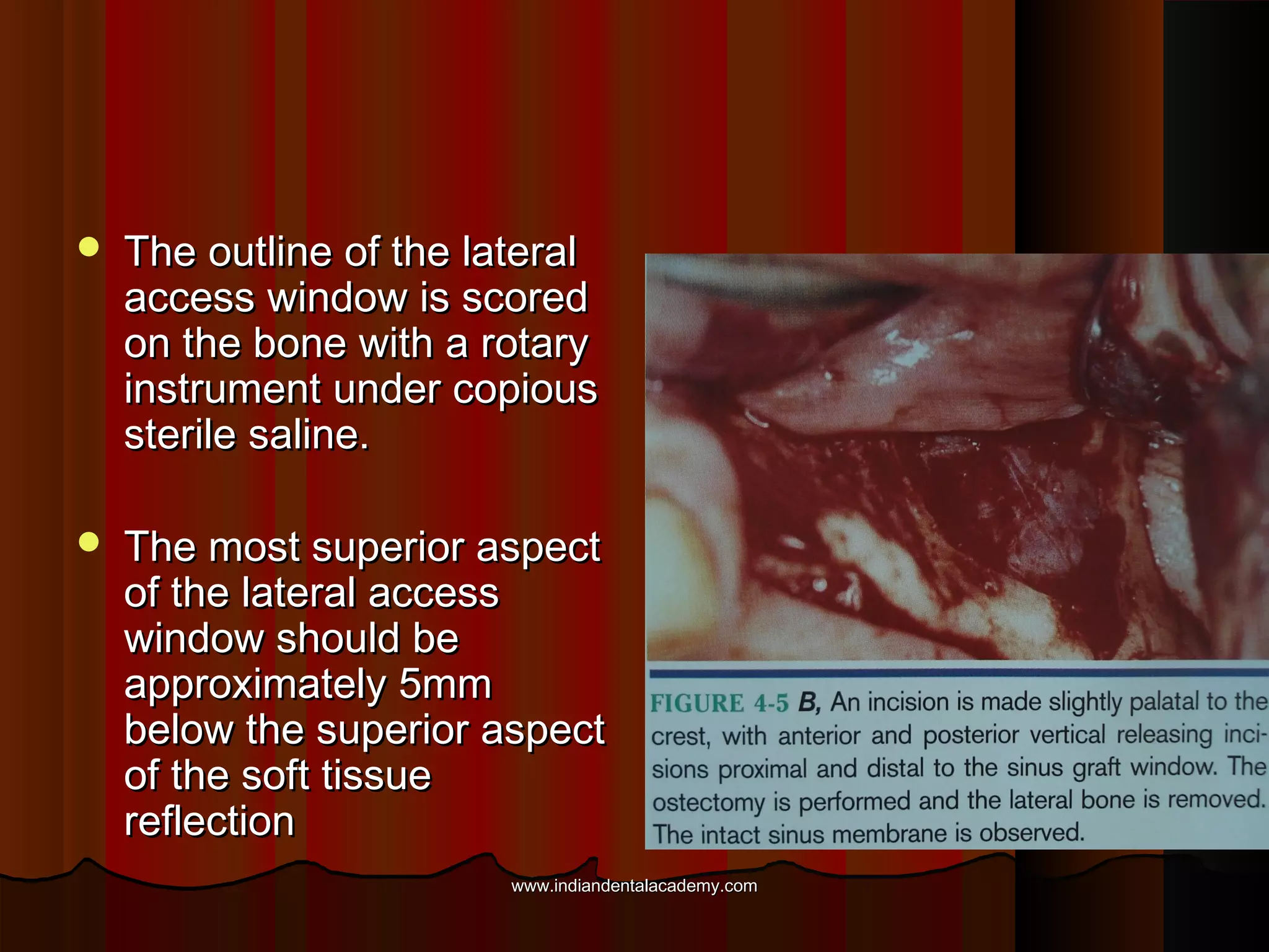  The outline of the lateralThe outline of the lateral
access window is scoredaccess window is scored
on the bone with a rotaryon the bone with a rotary
instrument under copiousinstrument under copious
sterile saline.sterile saline.
 The most superior aspectThe most superior aspect
of the lateral accessof the lateral access
window should bewindow should be
approximately 5mmapproximately 5mm
below the superior aspectbelow the superior aspect
of the soft tissueof the soft tissue
reflectionreflection
www.indiandentalacademy.comwww.indiandentalacademy.com
 