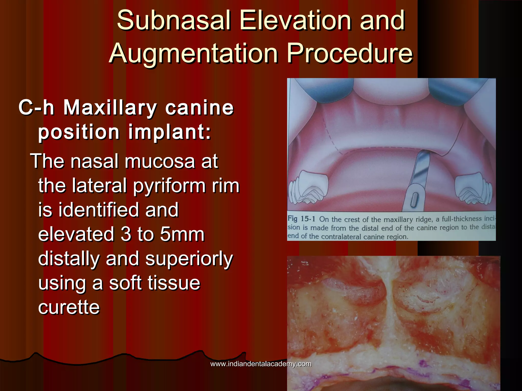 Subnasal Elevation andSubnasal Elevation and
Augmentation ProcedureAugmentation Procedure
C-h Maxillary canineC-h Maxillary canine
position implant:position implant:
The nasal mucosa atThe nasal mucosa at
the lateral pyriform rimthe lateral pyriform rim
is identified andis identified and
elevated 3 to 5mmelevated 3 to 5mm
distally and superiorlydistally and superiorly
using a soft tissueusing a soft tissue
curettecurette
www.indiandentalacademy.comwww.indiandentalacademy.com
 