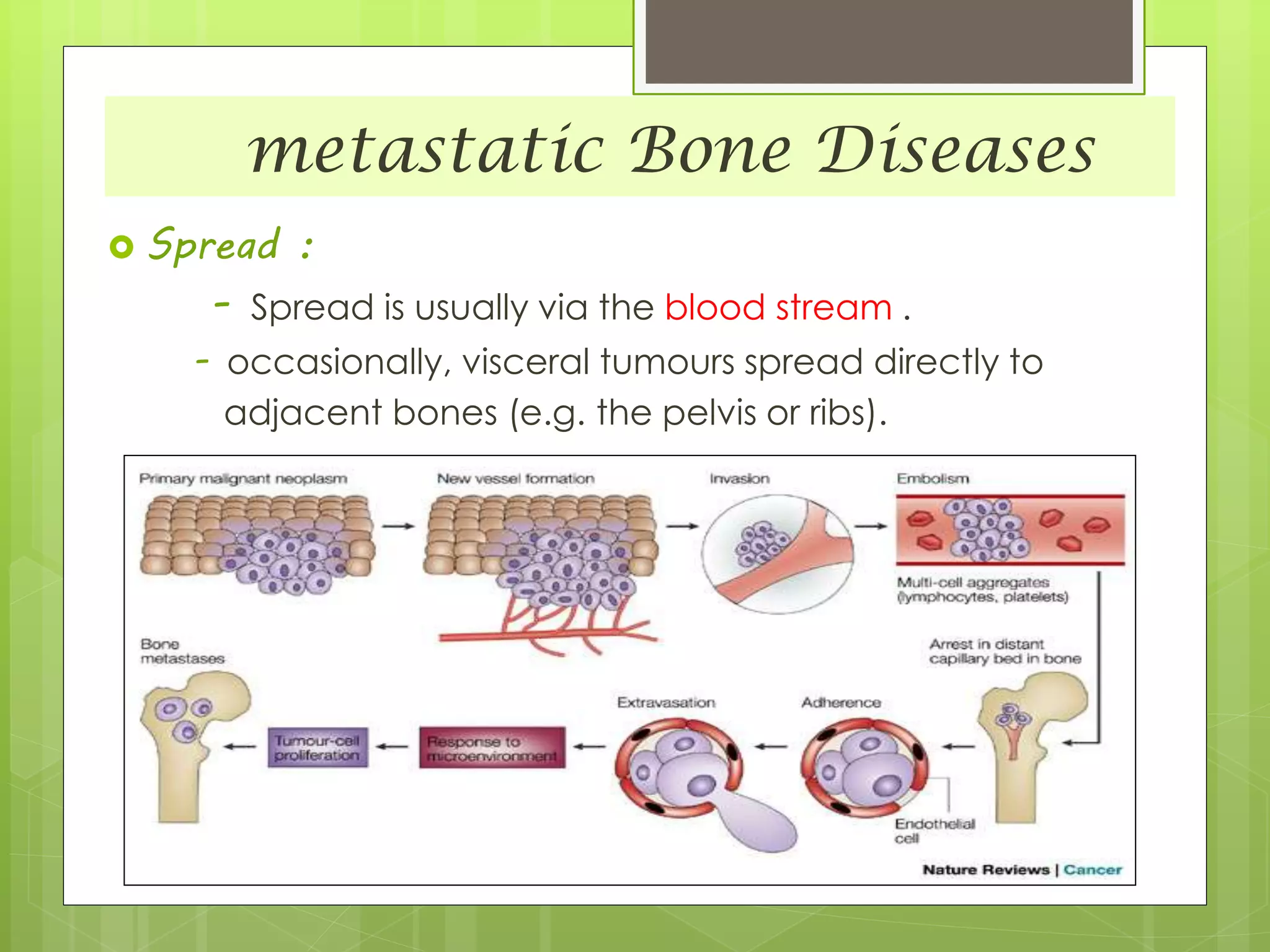 metastatic Bone Diseases
 Spread :
- Spread is usually via the blood stream .
- occasionally, visceral tumours spread directly to
adjacent bones (e.g. the pelvis or ribs).
 