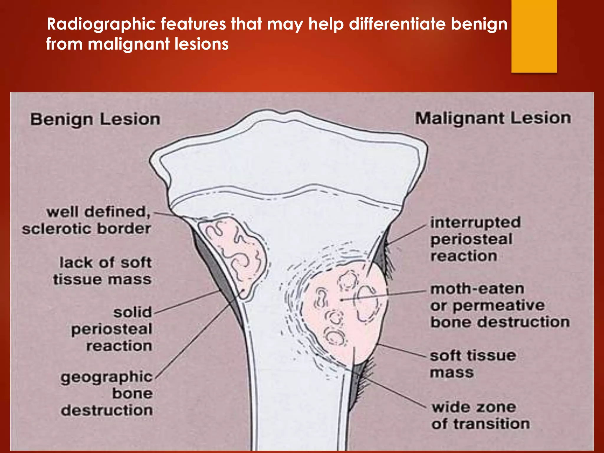 Radiographic features that may help differentiate benign
from malignant lesions
 