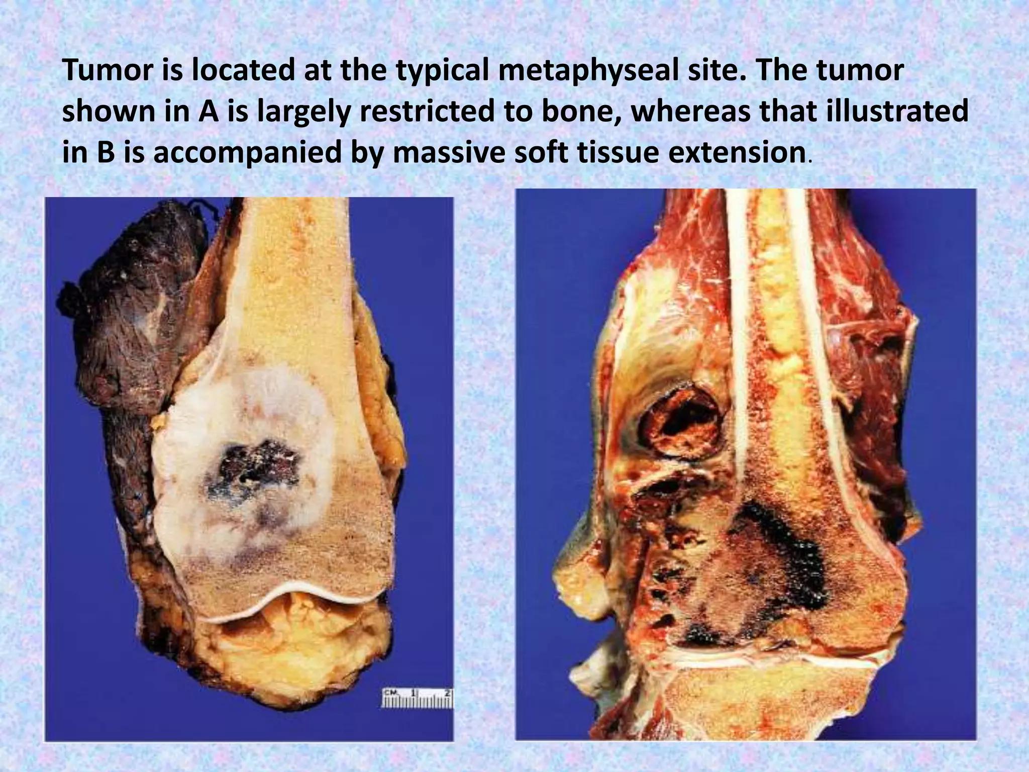 Tumor is located at the typical metaphyseal site. The tumor
shown in A is largely restricted to bone, whereas that illustrated
in B is accompanied by massive soft tissue extension.
 