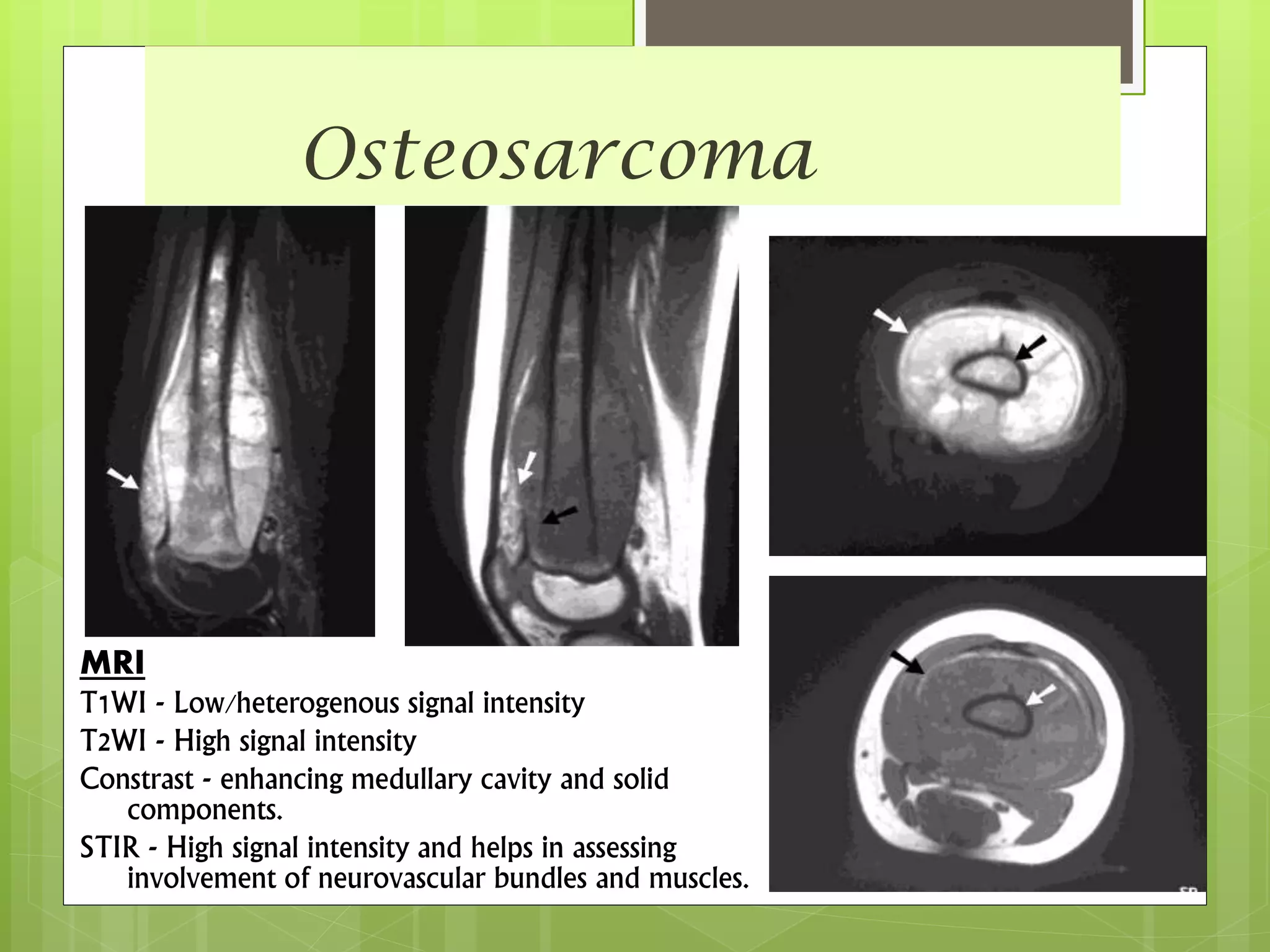Osteosarcoma
MRI
T1WI - Low/heterogenous signal intensity
T2WI - High signal intensity
Constrast - enhancing medullary cavity and solid
components.
STIR - High signal intensity and helps in assessing
involvement of neurovascular bundles and muscles.
 