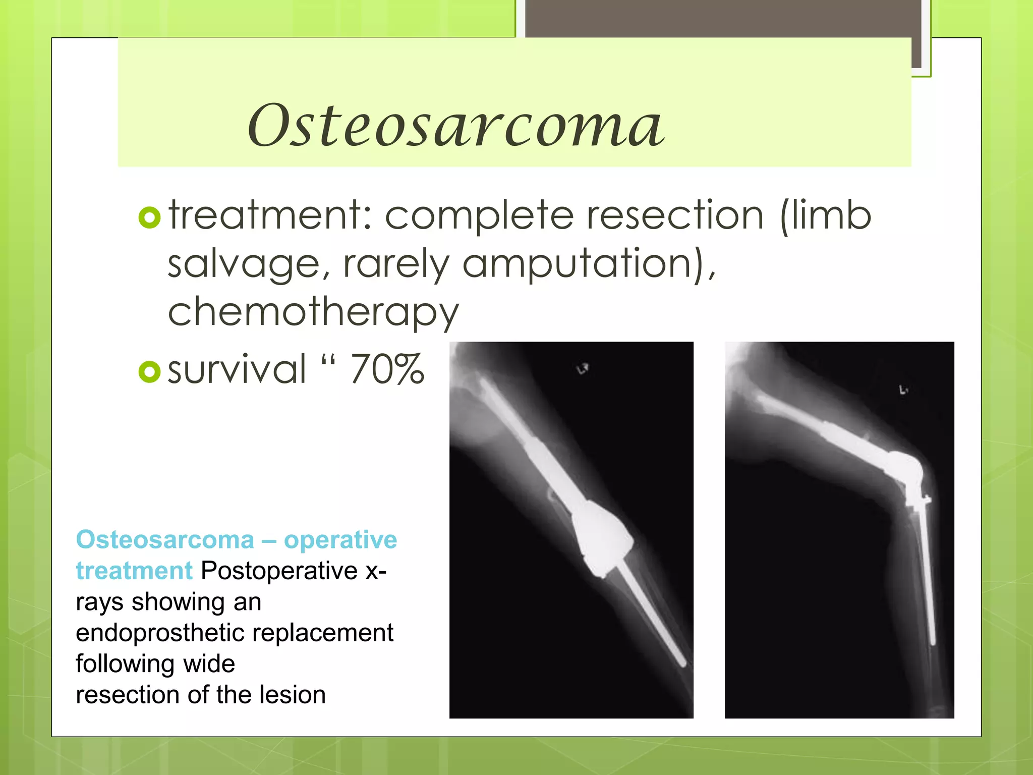 Osteosarcoma
treatment: complete resection (limb
salvage, rarely amputation),
chemotherapy
survival “ 70%
Osteosarcoma – operative
treatment Postoperative x-
rays showing an
endoprosthetic replacement
following wide
resection of the lesion
 