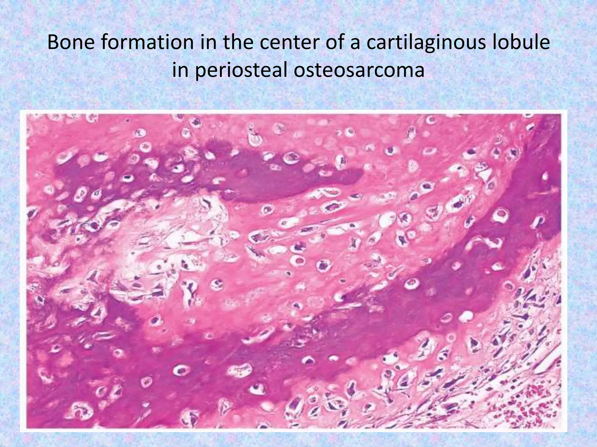 Bone formation in the center of a cartilaginous lobule
in periosteal osteosarcoma
 