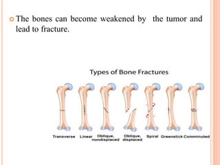  The bones can become weakened by the tumor and
lead to fracture.
 