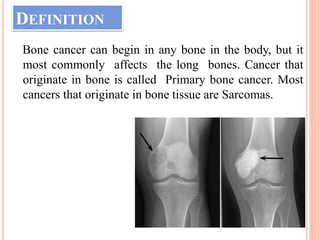 DEFINITION
Bone cancer can begin in any bone in the body, but it
most commonly affects the long bones. Cancer that
originate in bone is called Primary bone cancer. Most
cancers that originate in bone tissue are Sarcomas.
 