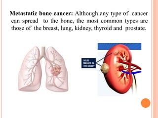 Metastatic bone cancer: Although any type of cancer
can spread to the bone, the most common types are
those of the breast, lung, kidney, thyroid and prostate.
 