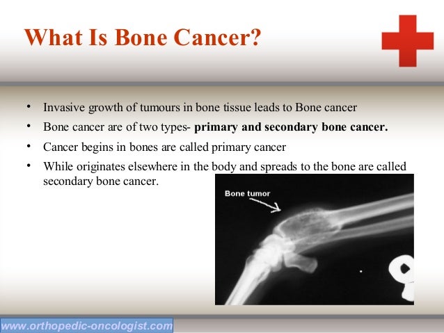bone-cancer-ppt