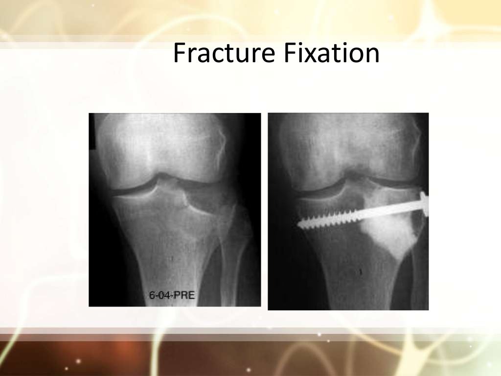 Bone cement.pptx 2 its science and cementing technique and safe surgi…