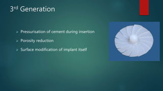 3rd Generation
 Pressurisation of cement during insertion
 Porosity reduction
 Surface modification of implant itself
 