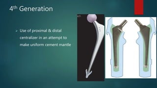 4th Generation
 Use of proximal & distal
centralizer in an attempt to
make uniform cement mantle
 