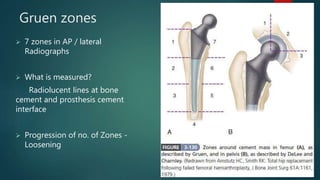 Gruen zones
 7 zones in AP / lateral
Radiographs
 What is measured?
Radiolucent lines at bone
cement and prosthesis cement
interface
 Progression of no. of Zones -
Loosening
 