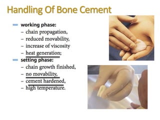 Handling Of Bone Cement
 