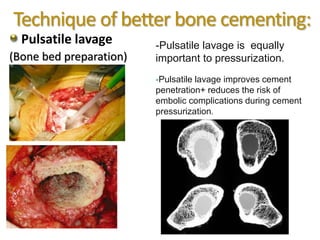 Technique of better bone cementing:
Pulsatile lavage
(Bone bed preparation)
-Pulsatile lavage is equally
important to pressurization.
-Pulsatile lavage improves cement
penetration+ reduces the risk of
embolic complications during cement
pressurization.
 