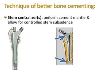 Technique of better bone cementing:
Stem centralizer(s): uniform cement mantle &
allow for controlled stem subsidence
 