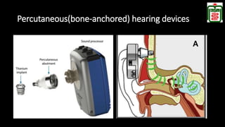 Bone Conduction Hearing Devices(BCHDs) | PPTX