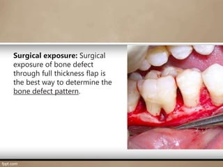 BONE DEFECTS lecture in periodontology. | PPTX