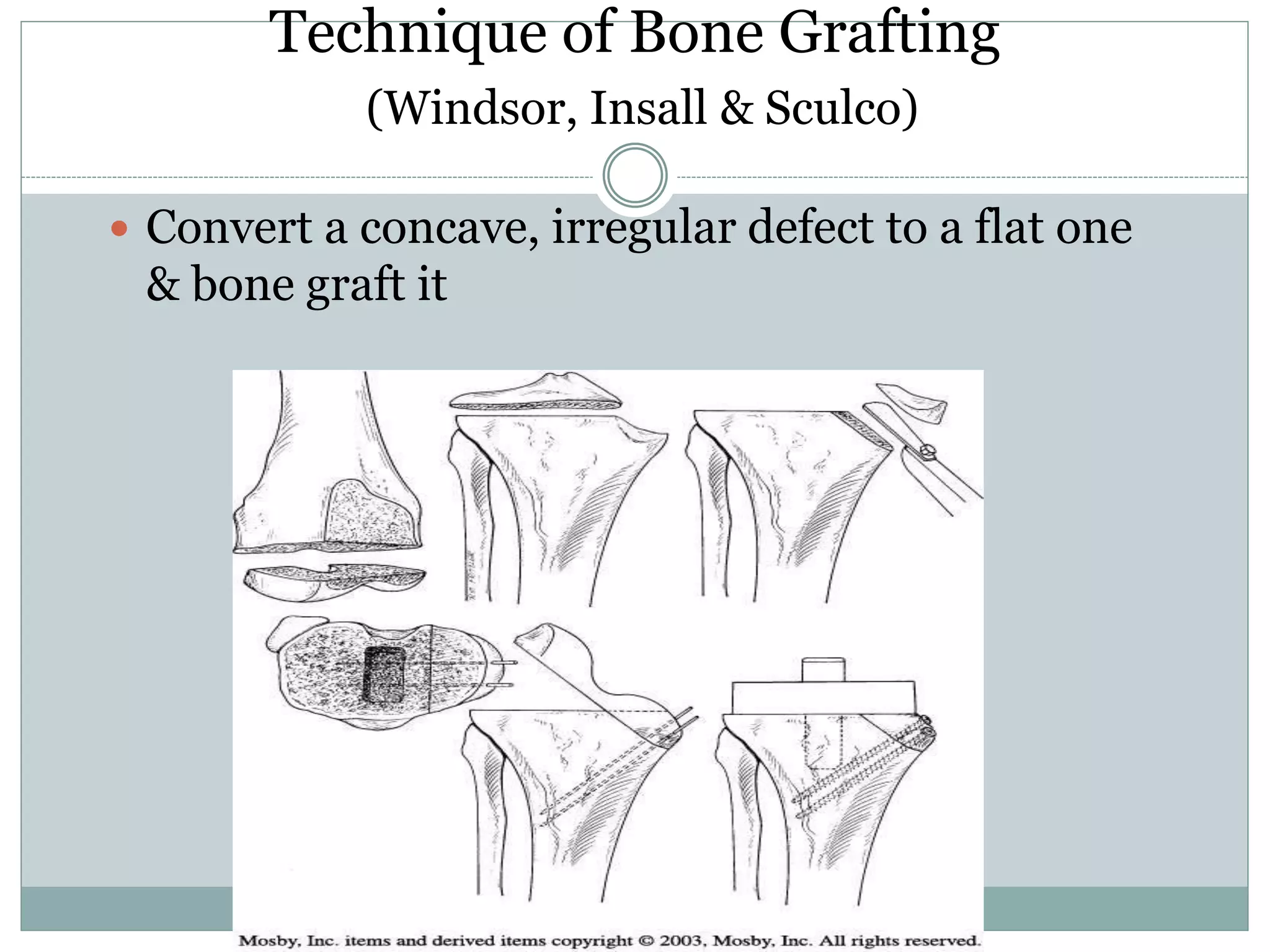 Bone defects in tkr | PPT