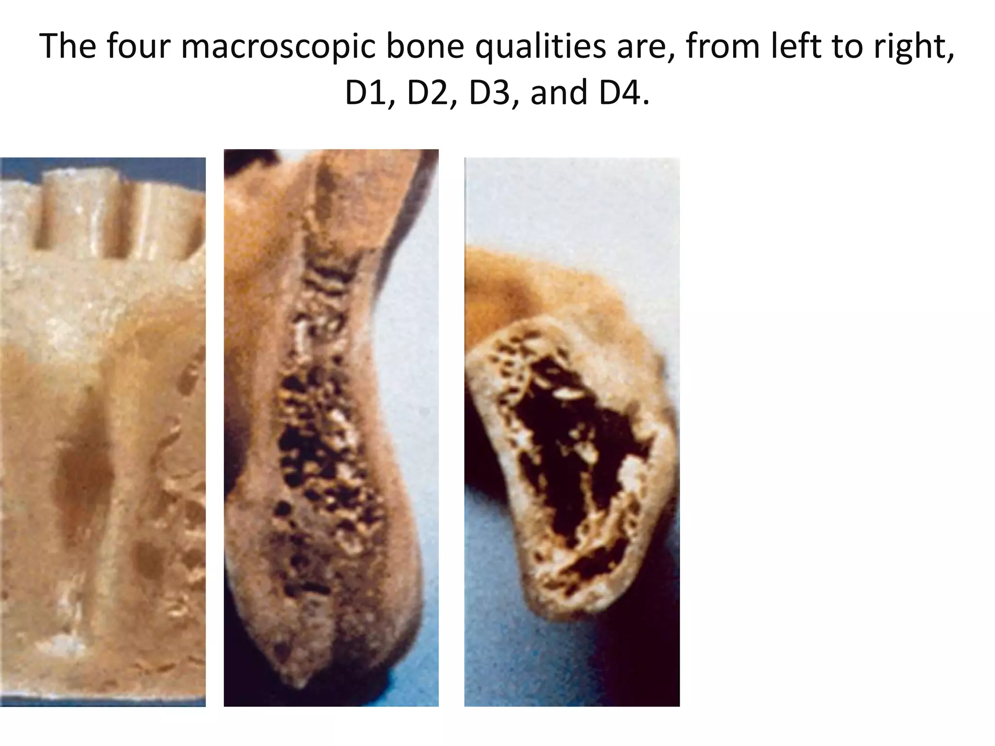 Bone density for dental implant. | PPTX