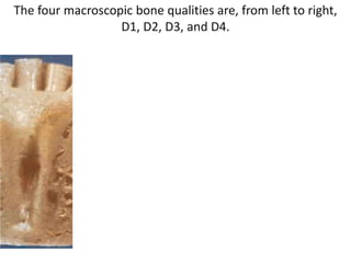 The four macroscopic bone qualities are, from left to right,
D1, D2, D3, and D4.
 