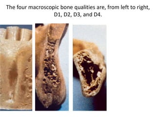 The four macroscopic bone qualities are, from left to right,
D1, D2, D3, and D4.
 