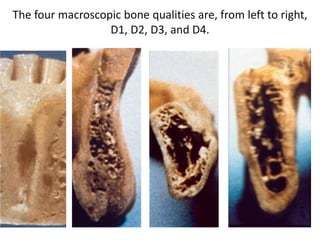 The four macroscopic bone qualities are, from left to right,
D1, D2, D3, and D4.
 