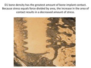 D1 bone density has the greatest amount of bone-implant contact.
Because stress equals force divided by area, the increase in the area of
contact results in a decreased amount of stress.
 