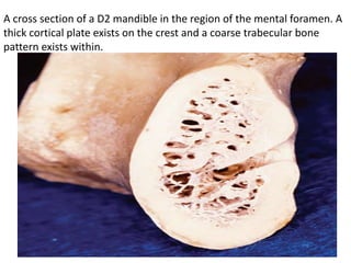 A cross section of a D2 mandible in the region of the mental foramen. A
thick cortical plate exists on the crest and a coarse trabecular bone
pattern exists within.
 