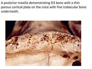 A posterior maxilla demonstrating D3 bone with a thin
porous cortical plate on the crest with fine trabecular bone
underneath.
 