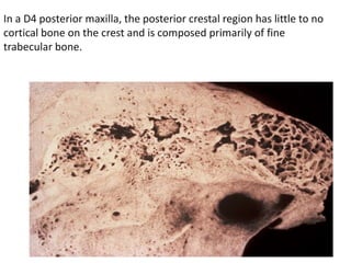 In a D4 posterior maxilla, the posterior crestal region has little to no
cortical bone on the crest and is composed primarily of fine
trabecular bone.
 