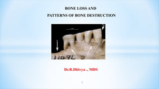 BONE LOSS AND
PATTERNS OF BONE DESTRUCTION
1
Dr.R.Dhivya ., MDS
 