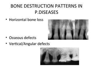 bone loss and bone_destruction_pattern ppt | PPT