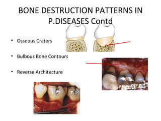 bone loss and bone_destruction_pattern ppt | PPT