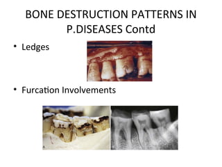 bone loss and bone_destruction_pattern ppt | PPT