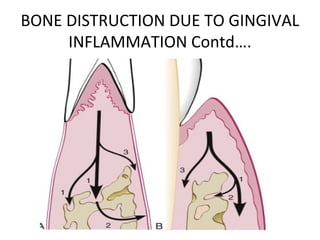 bone loss and bone_destruction_pattern ppt | PPT