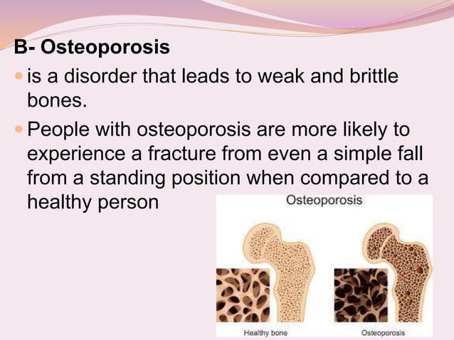 bone DISEASES.ppt