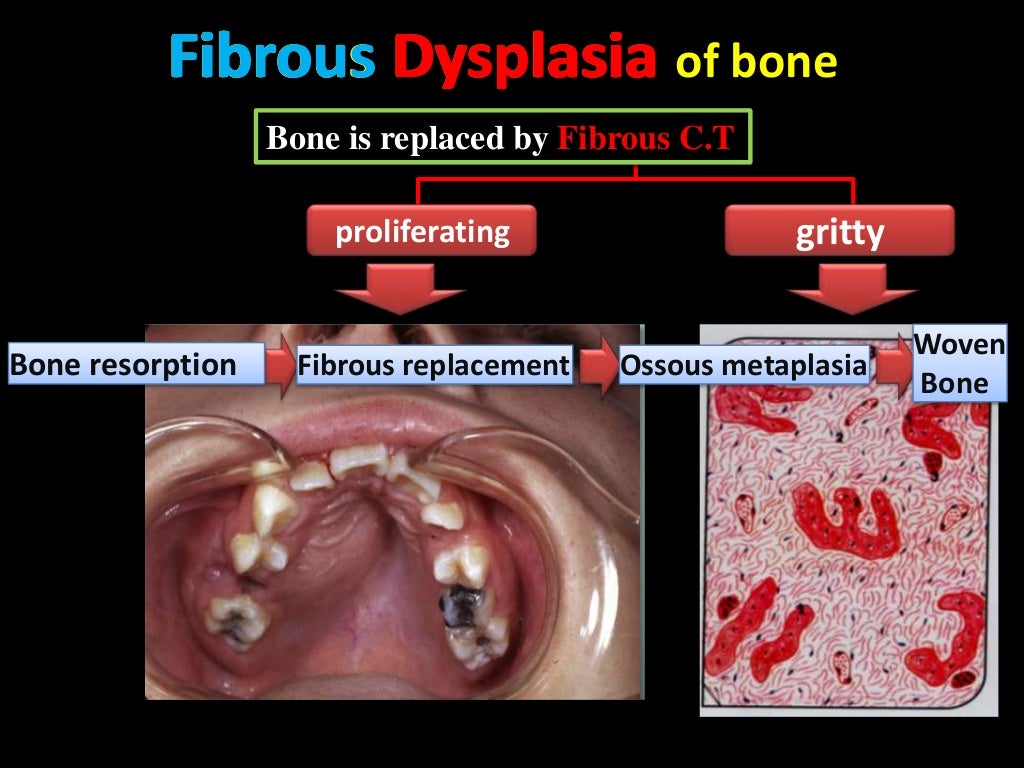 Bone diseases 2014
