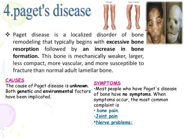 Bone disorders