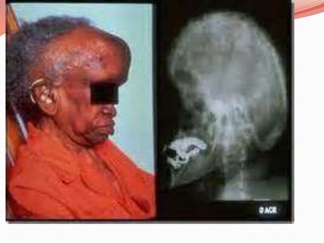 pain for paracetamol jaw disorders Bone