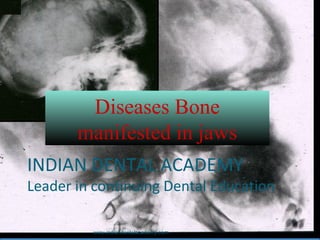 Diseases Bone
manifested in jaws
INDIAN DENTAL ACADEMY
Leader in continuing Dental Education
www.indiandentalacademy.com
 